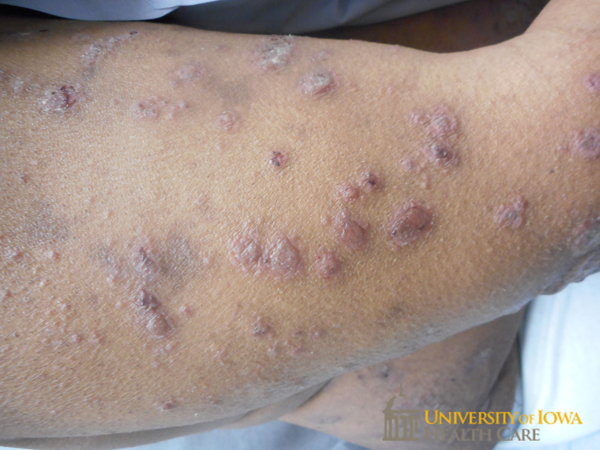 Pink to violaceous papules and plaques with silvery scale  on the extremity. (click images for higher resolution).